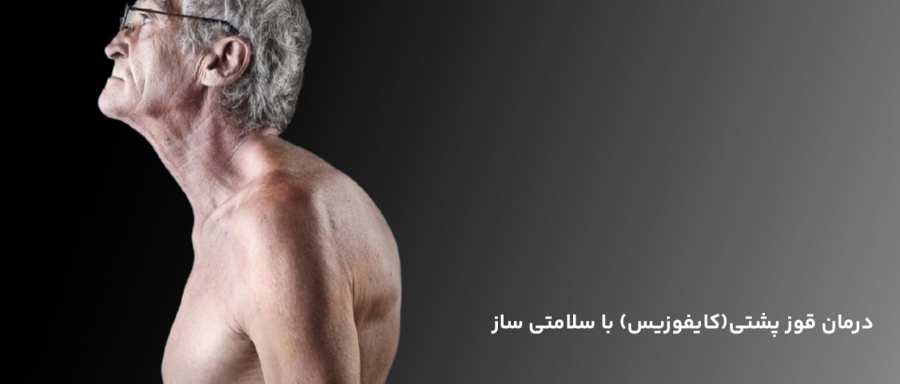 درمان قوز پشت
