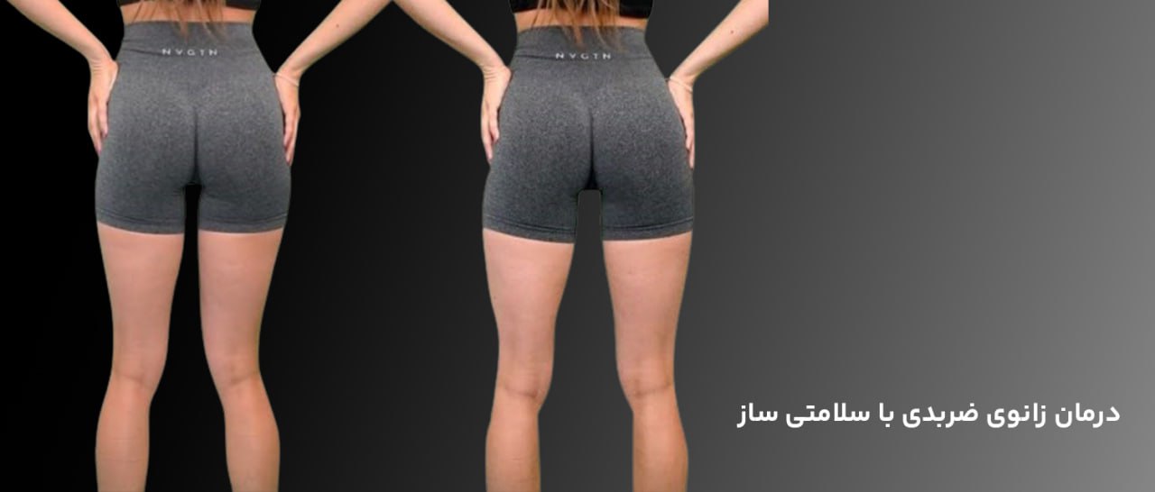 درمان زانو ضربدری