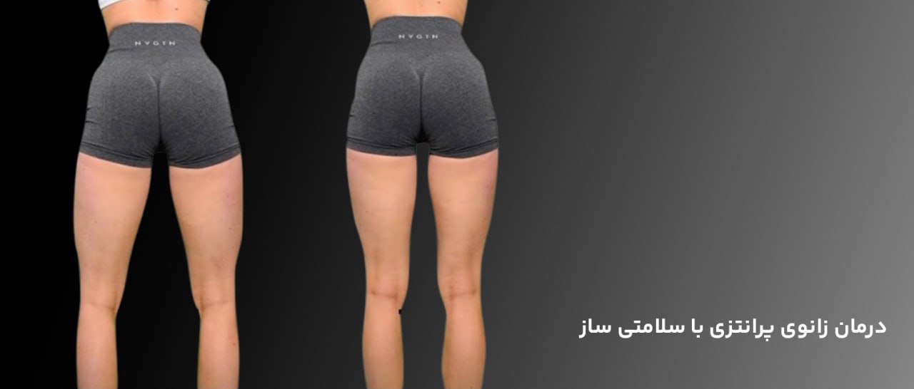 درمان زانو پرانتزی
