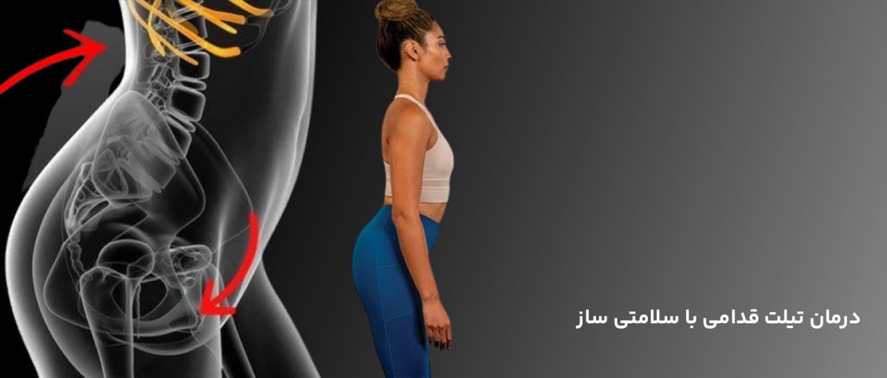 درمان تیلت قدامی
