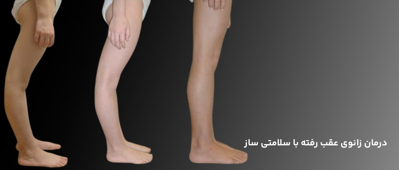 درمان زانو عقب رفته