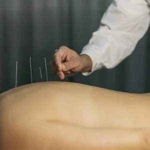 درمان کمر درد با طب سوزنی