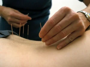 طب سوزنی چیست و چه تاثیری روی کمر درد دارد؟