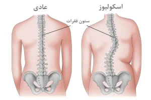 درمان اسکولیوز