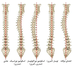 انواع اسکولیوز