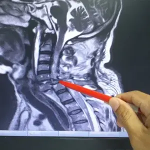 دیسک گردن میتواند باعث شانه درد شود.