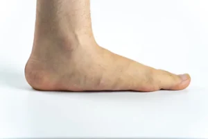 نحوه انجام تست ایستادن روی یک پاشنه جهت تشخیص ضعف تاندون پا