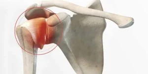 موقعیت کپسولیت چسبنده