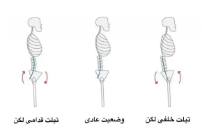 تاثیر کفش مناسب و استاندارد بر مرکز ثقل بدن و راستای لگن