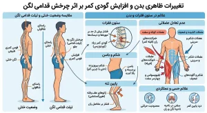 تغییرات ظاهری بدن و افزایش گودی کمر بر اثر چرخش قدامی لگن