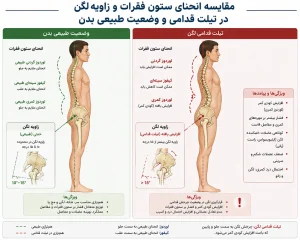 مقایسه انحنای ستون فقرات و زاویه لگن در تیلت قدامی و وضعیت طبیعی بدن