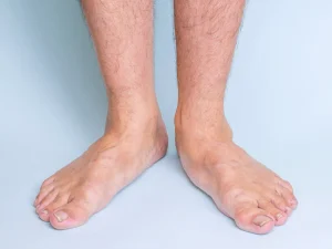 عکس رادیولوژی ایستاده پا تحت تحمل وزن برای بررسی زاویه ماری