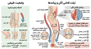 انحراف زانوها به سمت داخل و انحراف زنجیره حرکتی در تیلت قدامی لگن