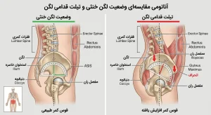آناتومی مقایسه‌ای وضعیت لگن خنثی و تیلت قدامی لگن