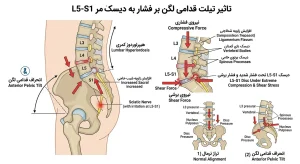 تاثیر تیلت قدامی لگن بر فشار به دیسک کمر L5-S1