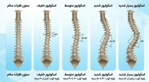 مقایسه درجات اسکولیوز از خفیف تا شدید در نمای سه بعدی ستون فقرات