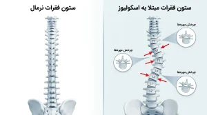 مقایسه ساختار ستون فقرات سالم و مبتلا به اسکولیوز