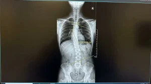 نحوه اندازه‌گیری زاویه کوب در کلیشه رادیوگرافی اسکولیوز