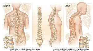 مقایسه آناتومی تفاوت اسکولیوز و کیفوز در ستون فقرات